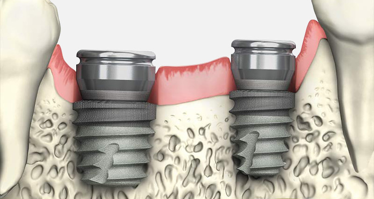 Синус-ліфтинг