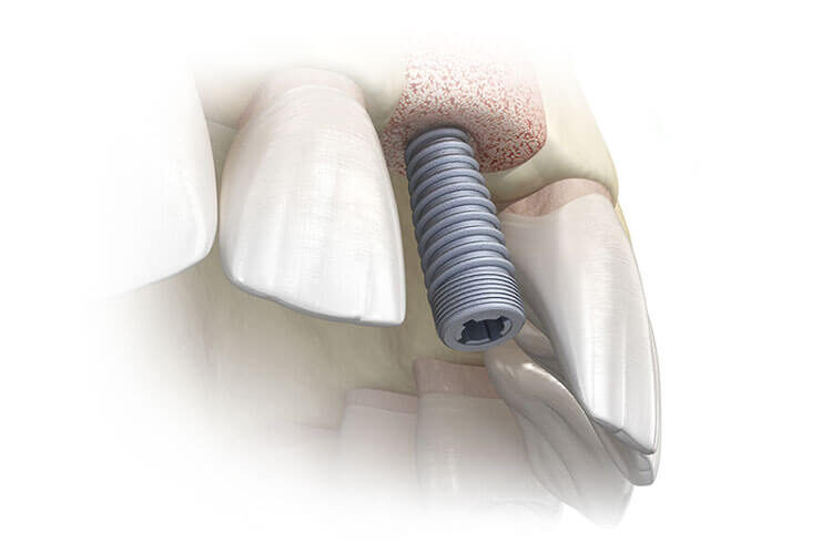 Синус-ліфтинг