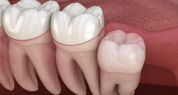 Видалення зубів