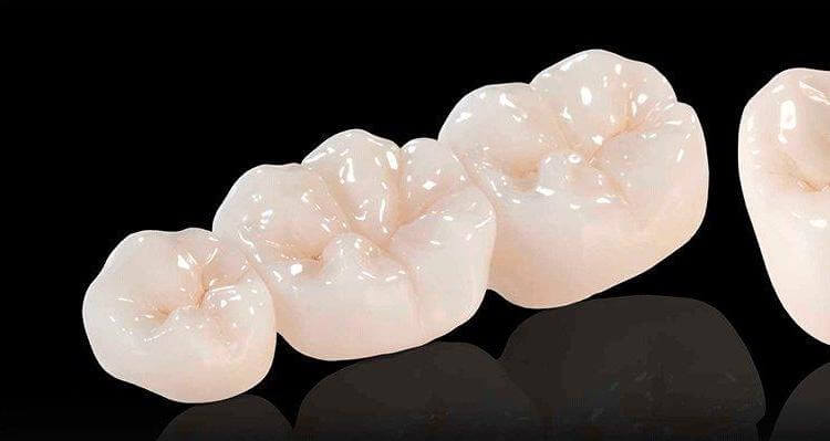 Зубні мости