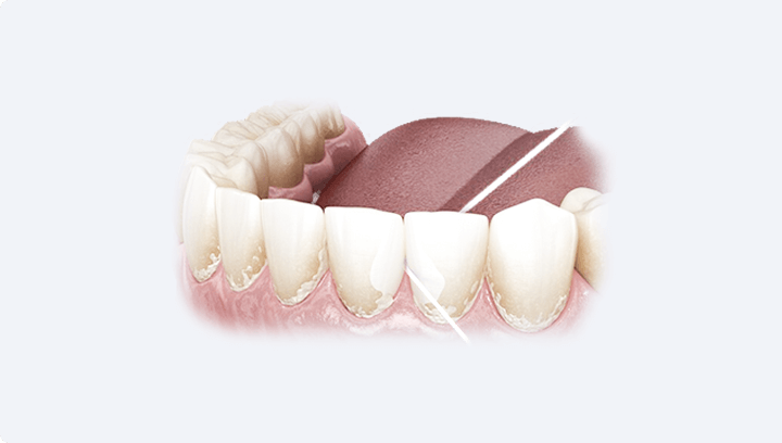 Імплантація передніх зубів
