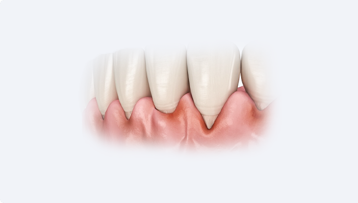 Імплантація передніх зубів