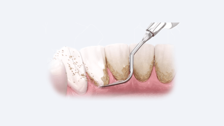 Імплантація передніх зубів
