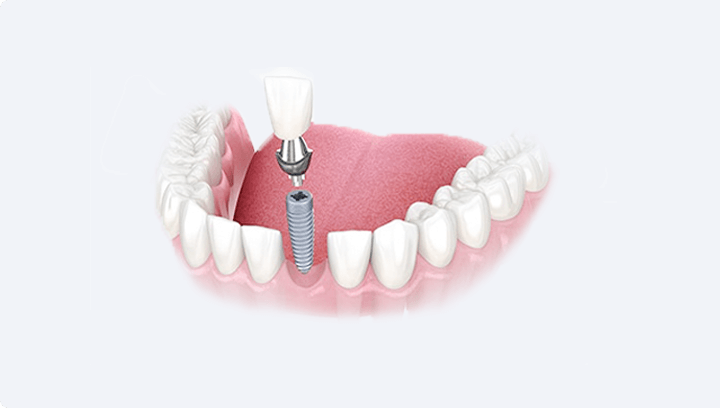 Імплантація передніх зубів