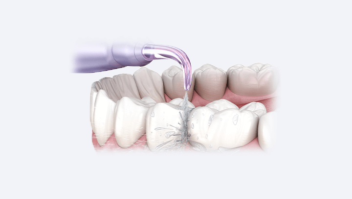 Імплантація передніх зубів
