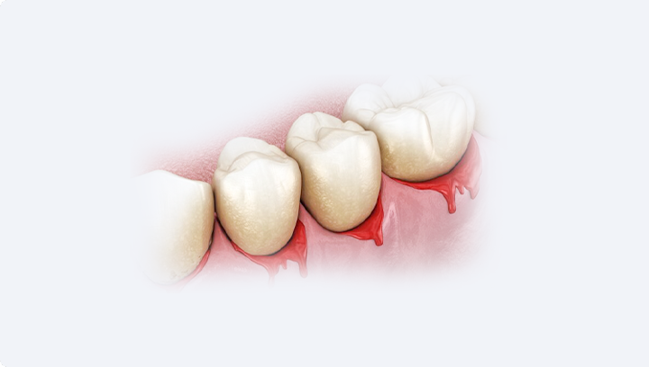 Імплантація передніх зубів