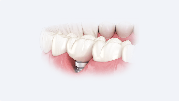 Імплантація передніх зубів