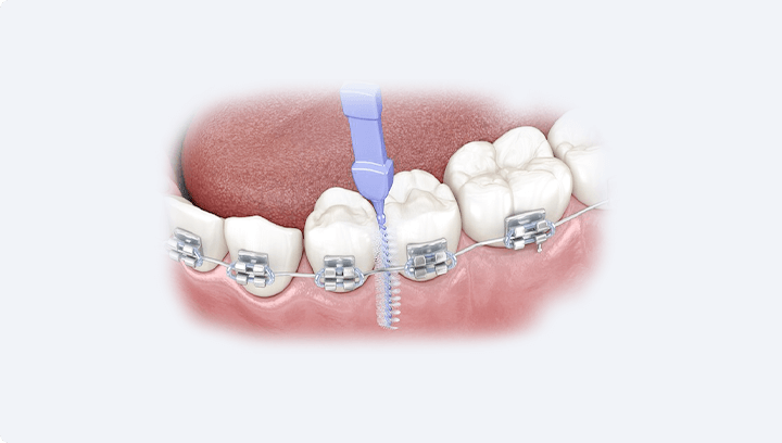 Імплантація передніх зубів