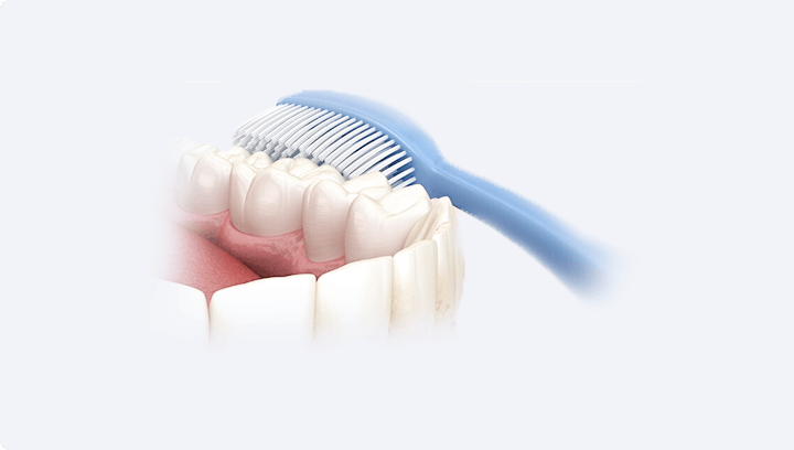 Імплантація передніх зубів