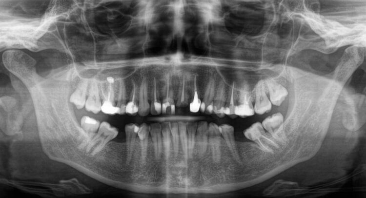 Відновлення зубів без імплантації