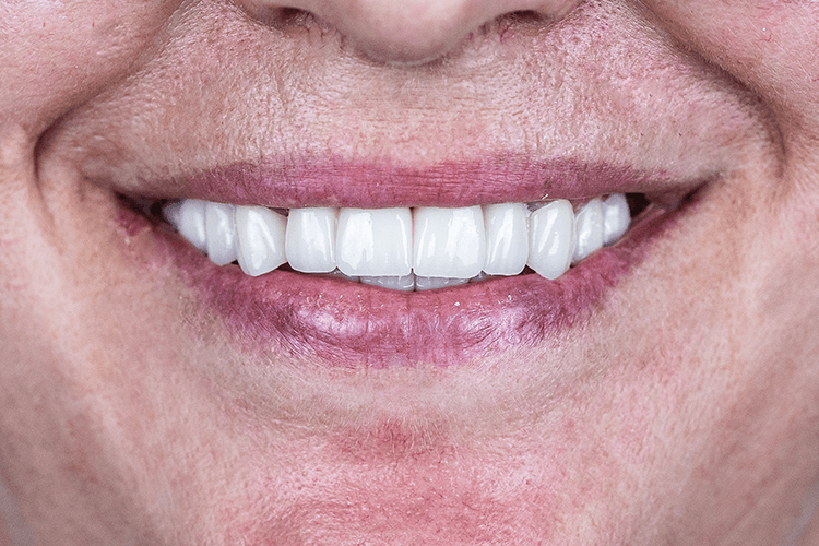 Протезирование мостовидными протезами