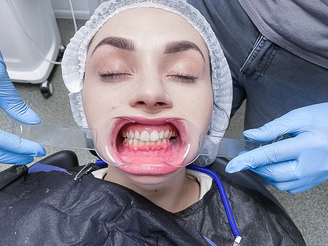 Протезування зубів на імплантах