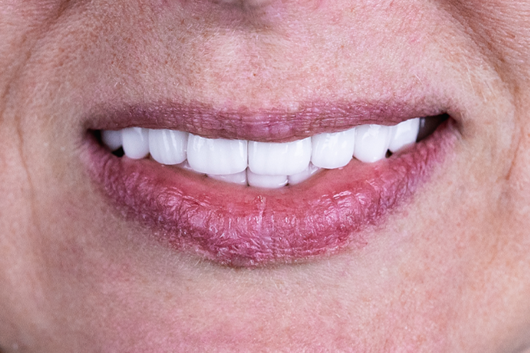 Восстановление зубов без имплантации