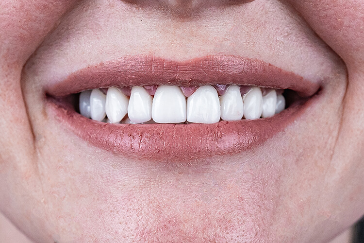 Протезирование зубов коронками и винирами