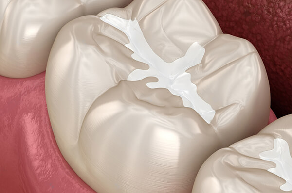 Лікування карієсу