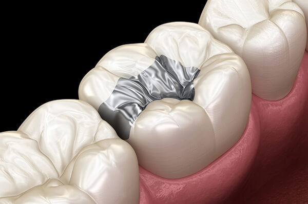 Лікування карієсу