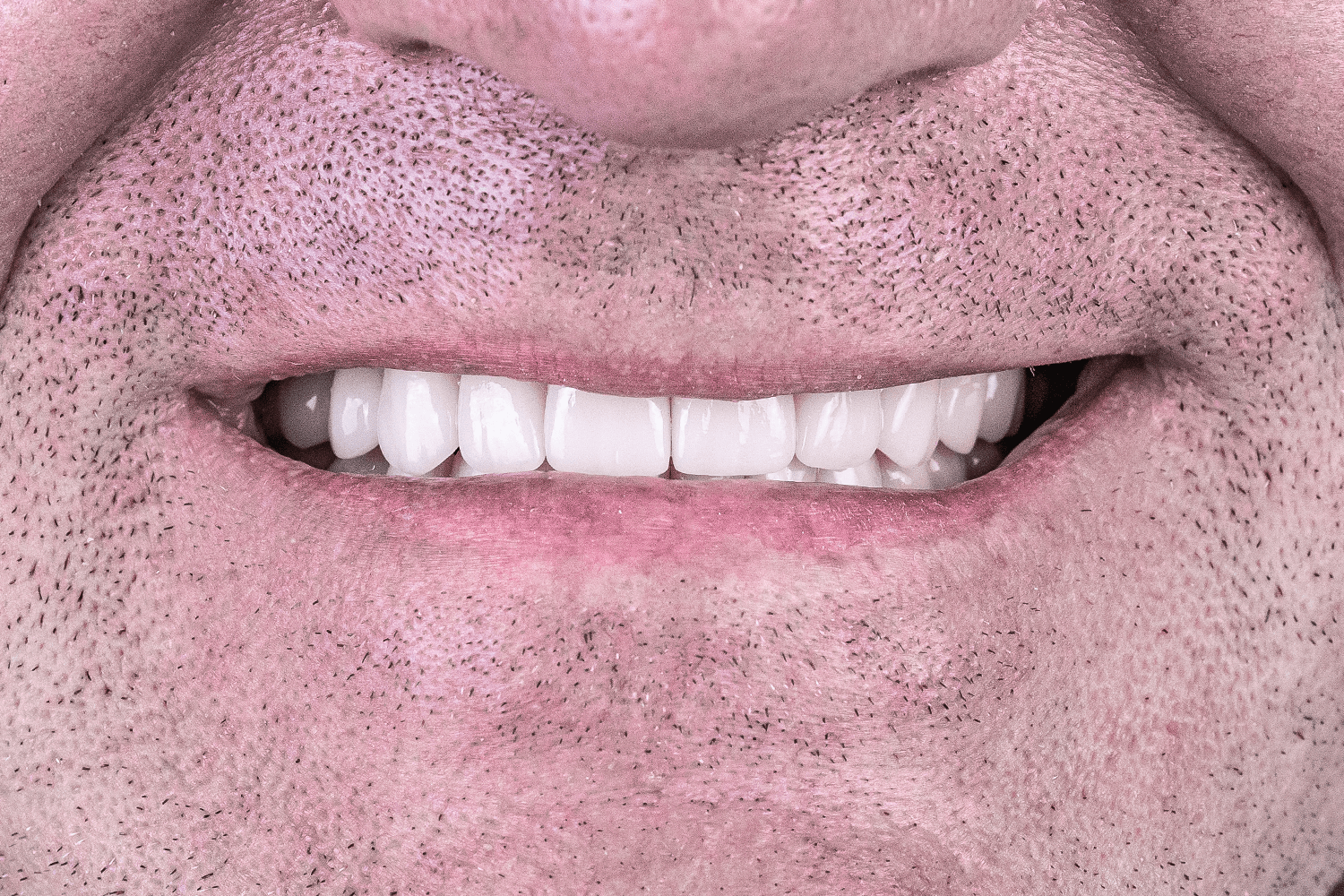 Імплантація зубів all-on-4 та all-on-6