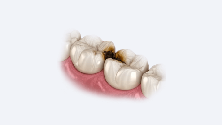 Ендодонтичне лікування