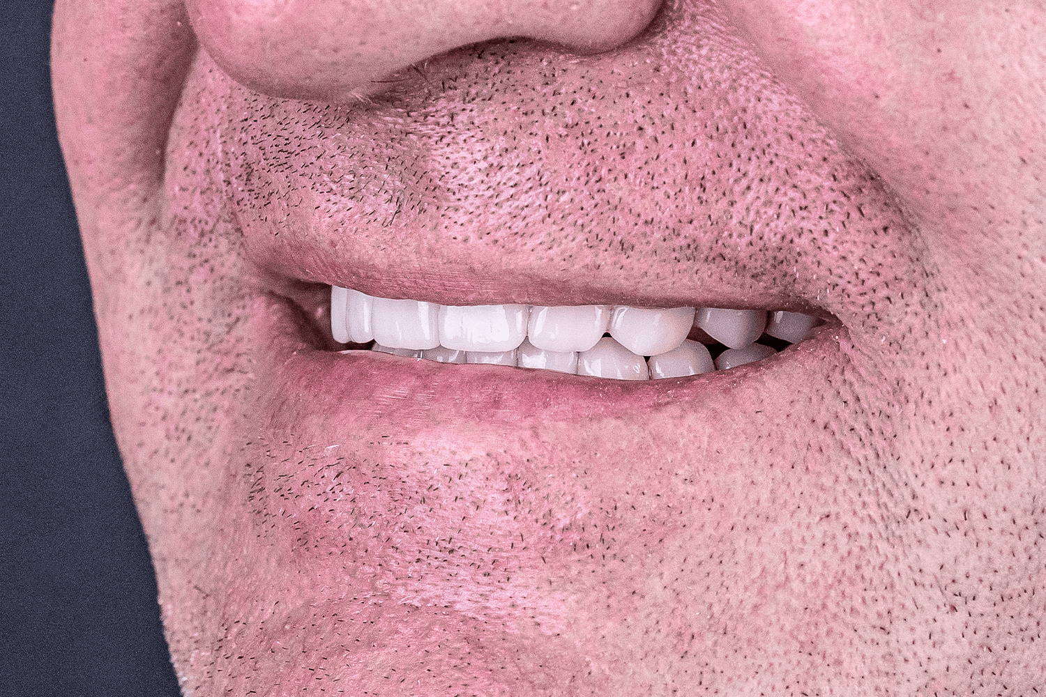 Імплантація зубів all-on-4 та all-on-6