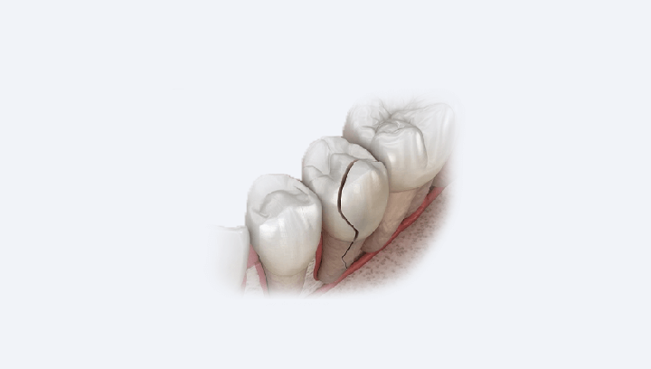 Ендодонтичне лікування