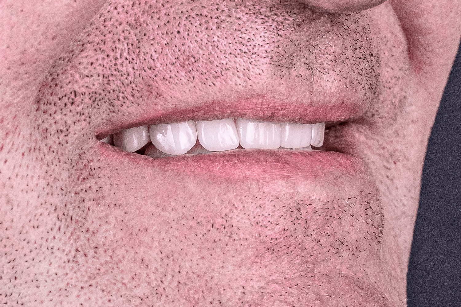 Імплантація зубів all-on-4 та all-on-6