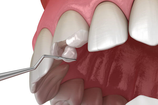 Реставрація зубів