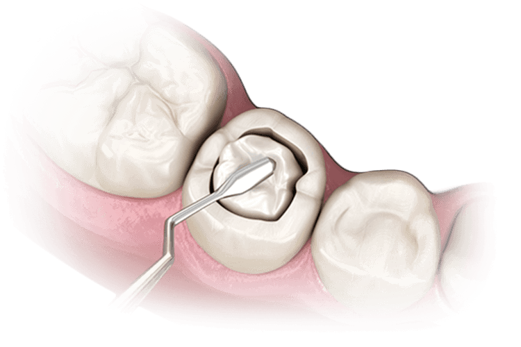 Реставрация (пломбирование) зубов
