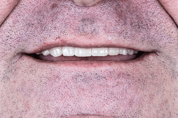 тимчасове протезування на імплантатах