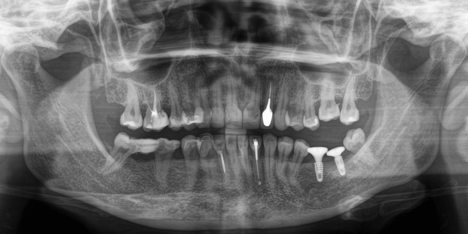 Имплантация и протезирование коронками