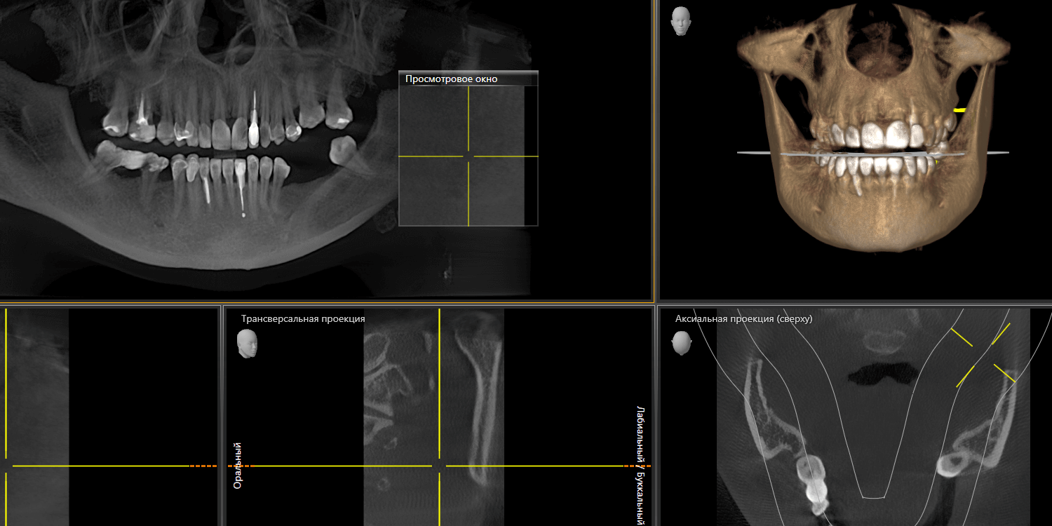 Имплантация и протезирование коронками