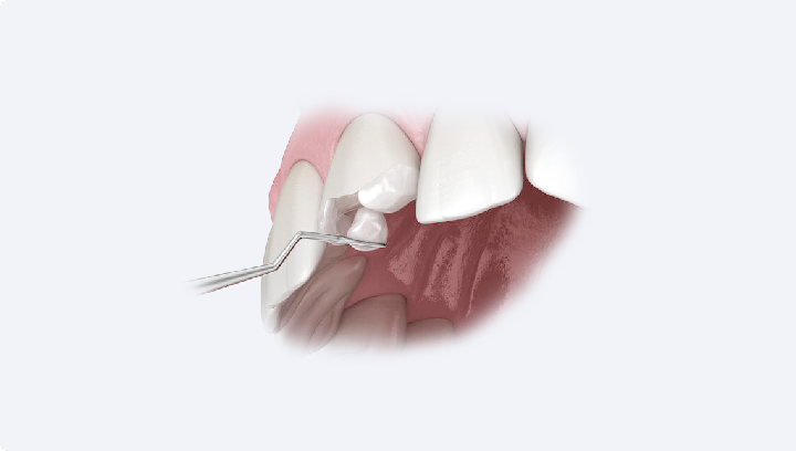 Виготовлення моделі майбутніх зубів
