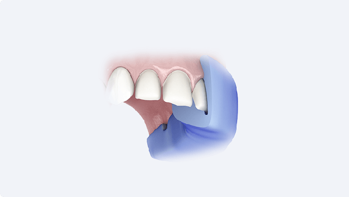 Виготовлення моделі майбутніх зубів