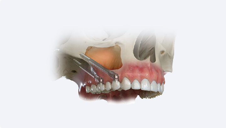 Імпланти Nobel Biocare