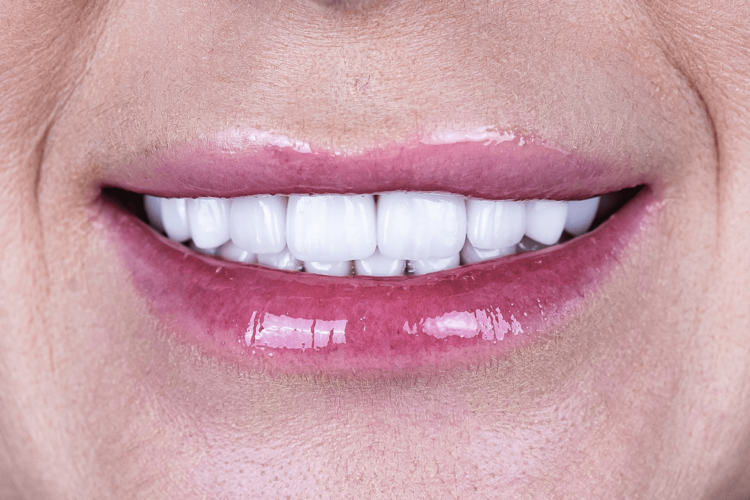 Имплантация и протезирование коронками