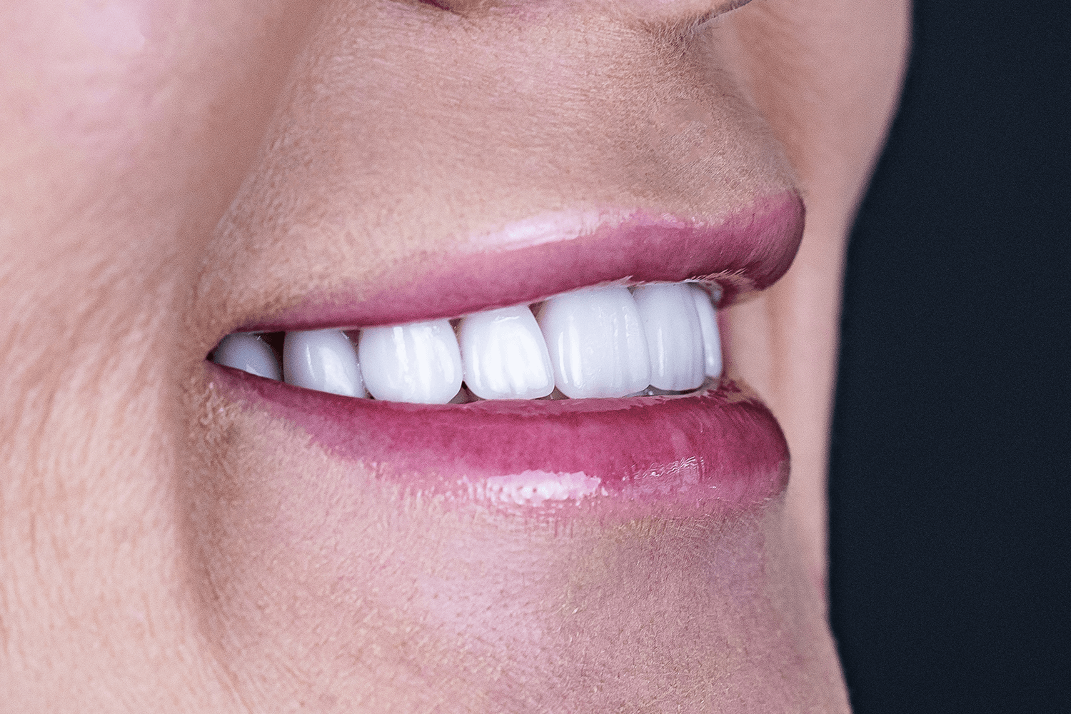 Імплантація й протезування коронками