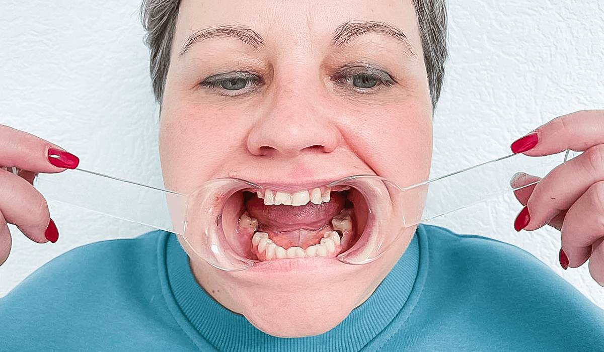 Протезування на імплантах коронками e.max