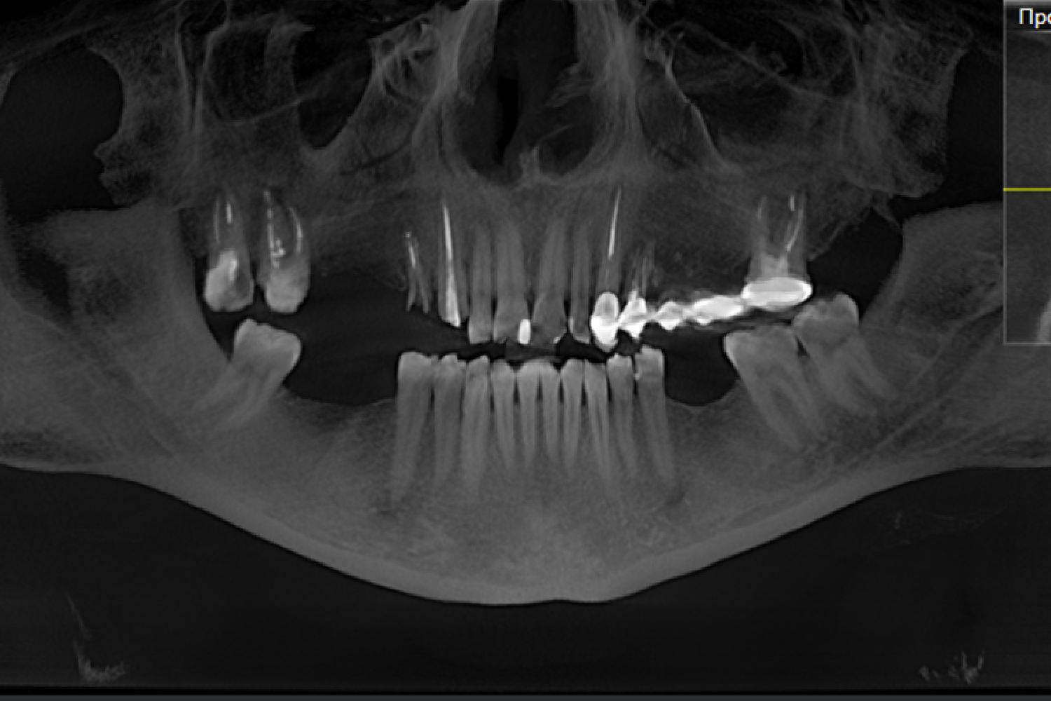 Протезування на імплантах коронками e.max