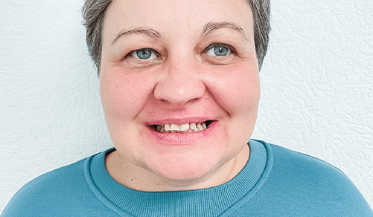 Протезування на імплантах коронками e.max