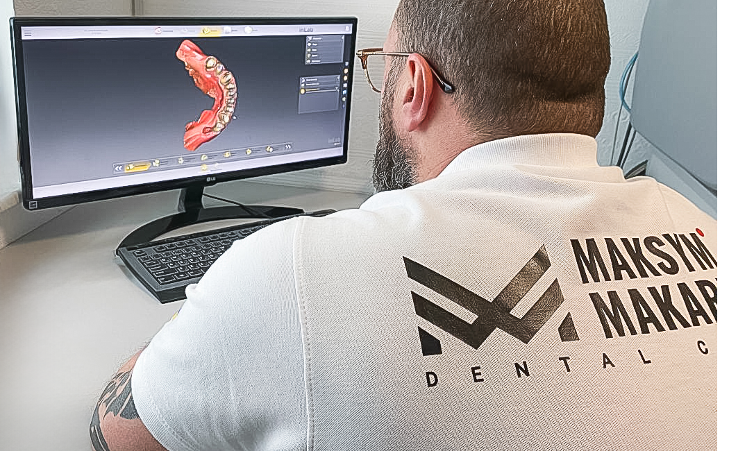 Імплантація та протезування коронками e.max