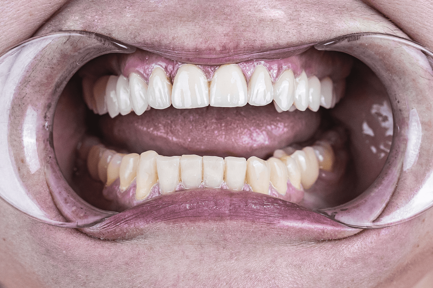 Протезування зубів керамічними коронками та мостовидними протезами (на верхній щелепі) з дисилікату літію E-max.