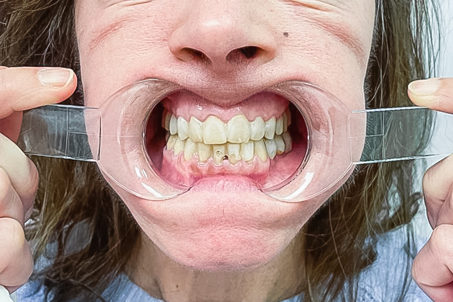 Імплантація та протезування коронками e.max