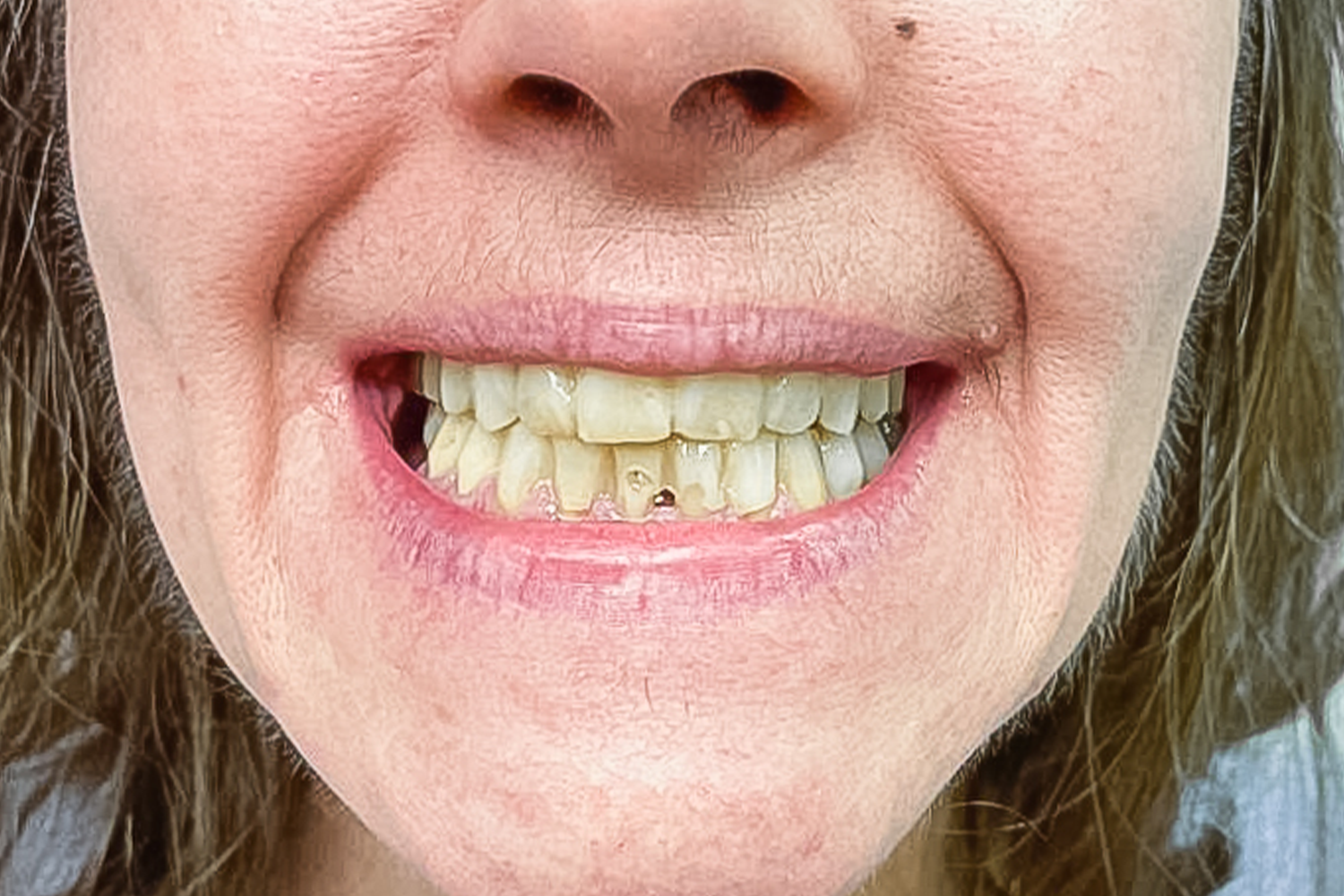 Імплантація та протезування коронками e.max