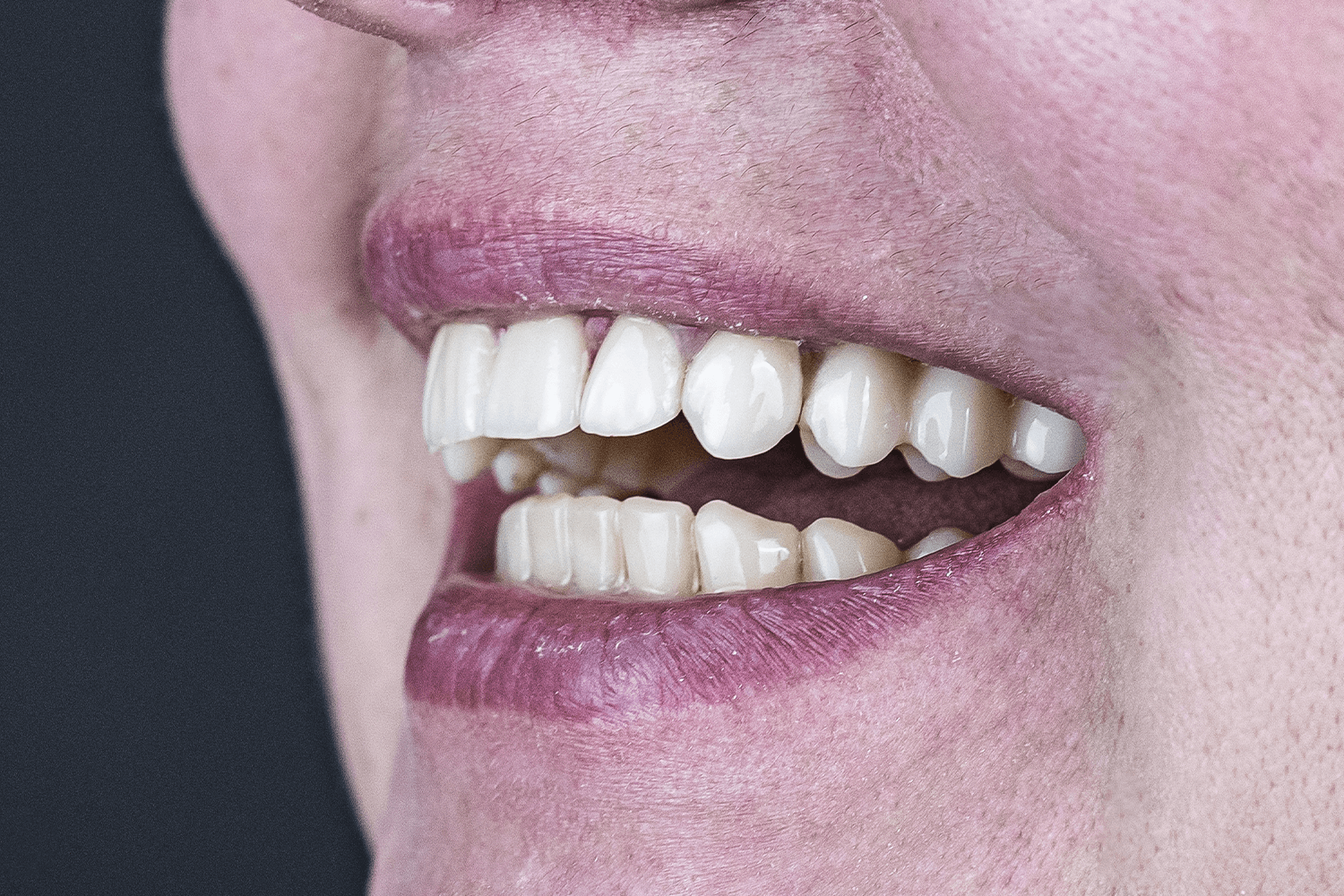 Протезування зубів керамічними коронками та мостовидними протезами (на верхній щелепі) з дисилікату літію E-max.