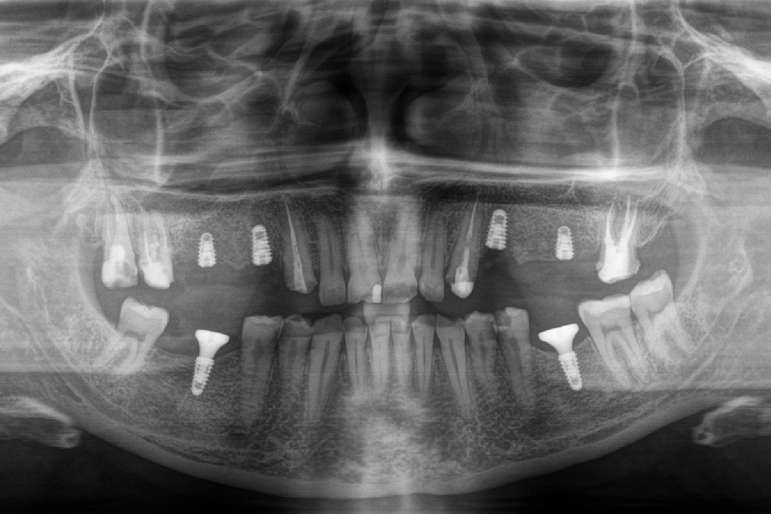 Протезування на імплантах коронками e.max