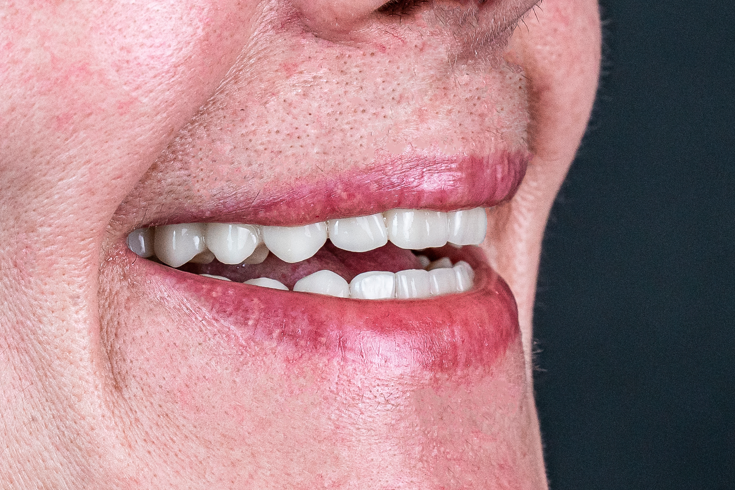 Імплантація та протезування коронками e.max