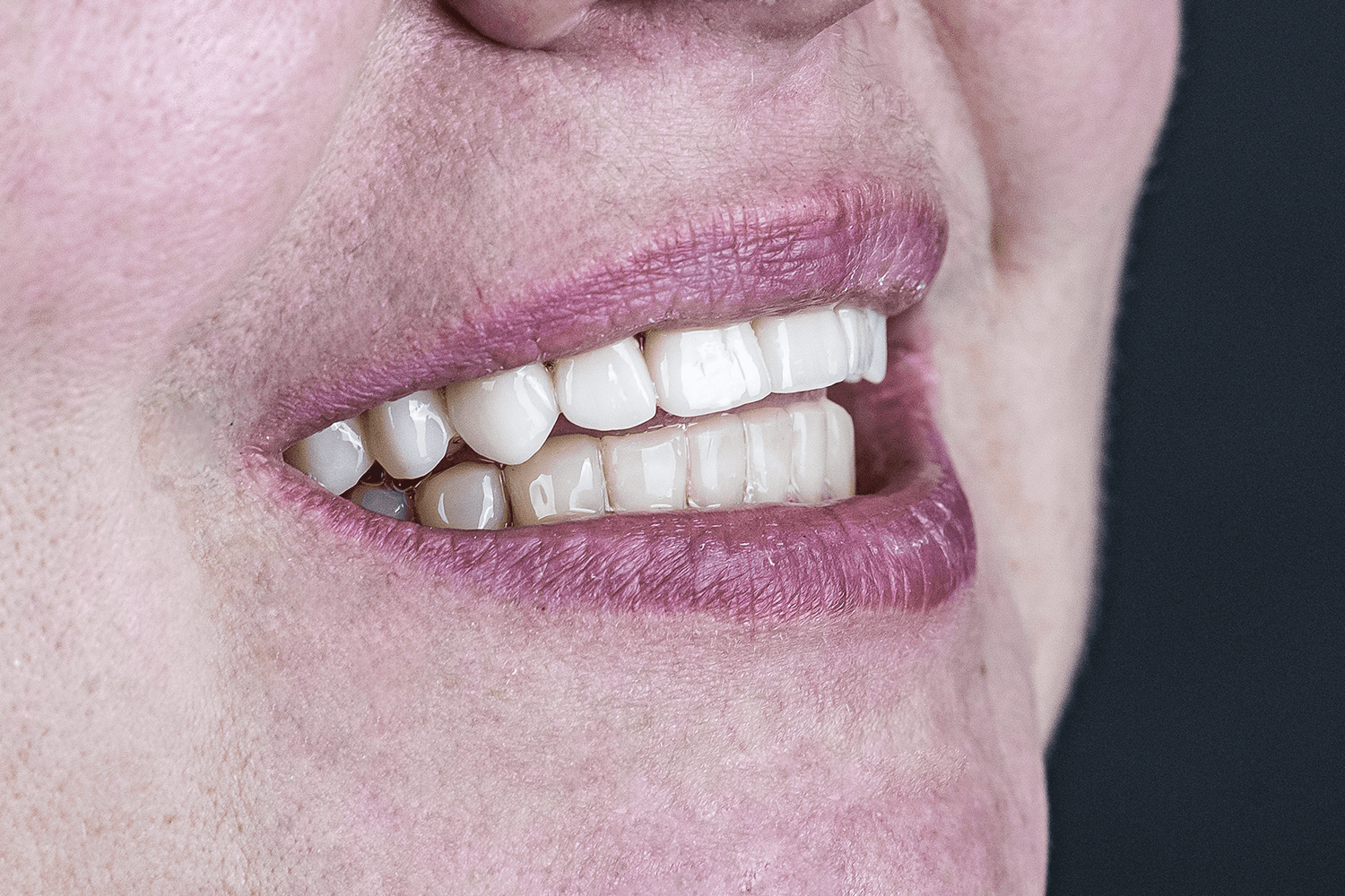 Протезування зубів керамічними коронками та мостовидними протезами (на верхній щелепі) з дисилікату літію E-max.