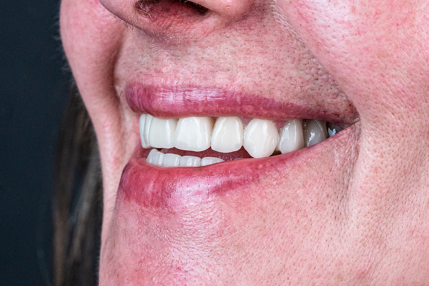 Імплантація та протезування коронками e.max