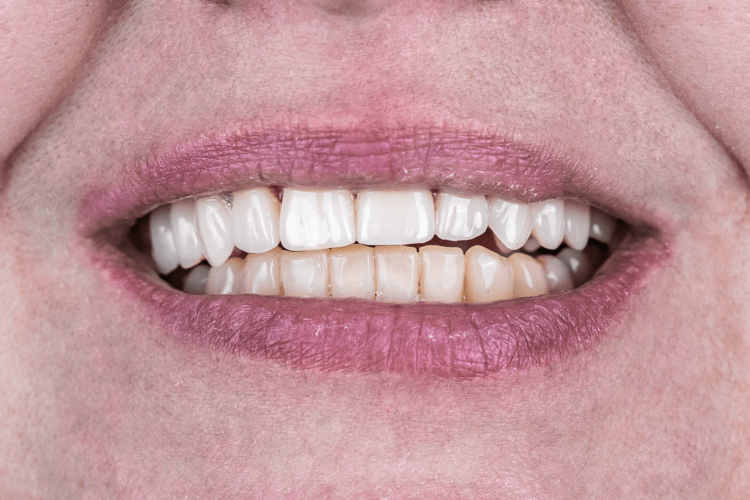 Протезирование на имплантах коронками E-max