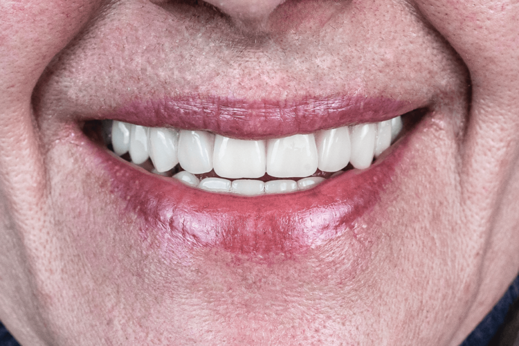 Имплантация и протезирование коронками E-max