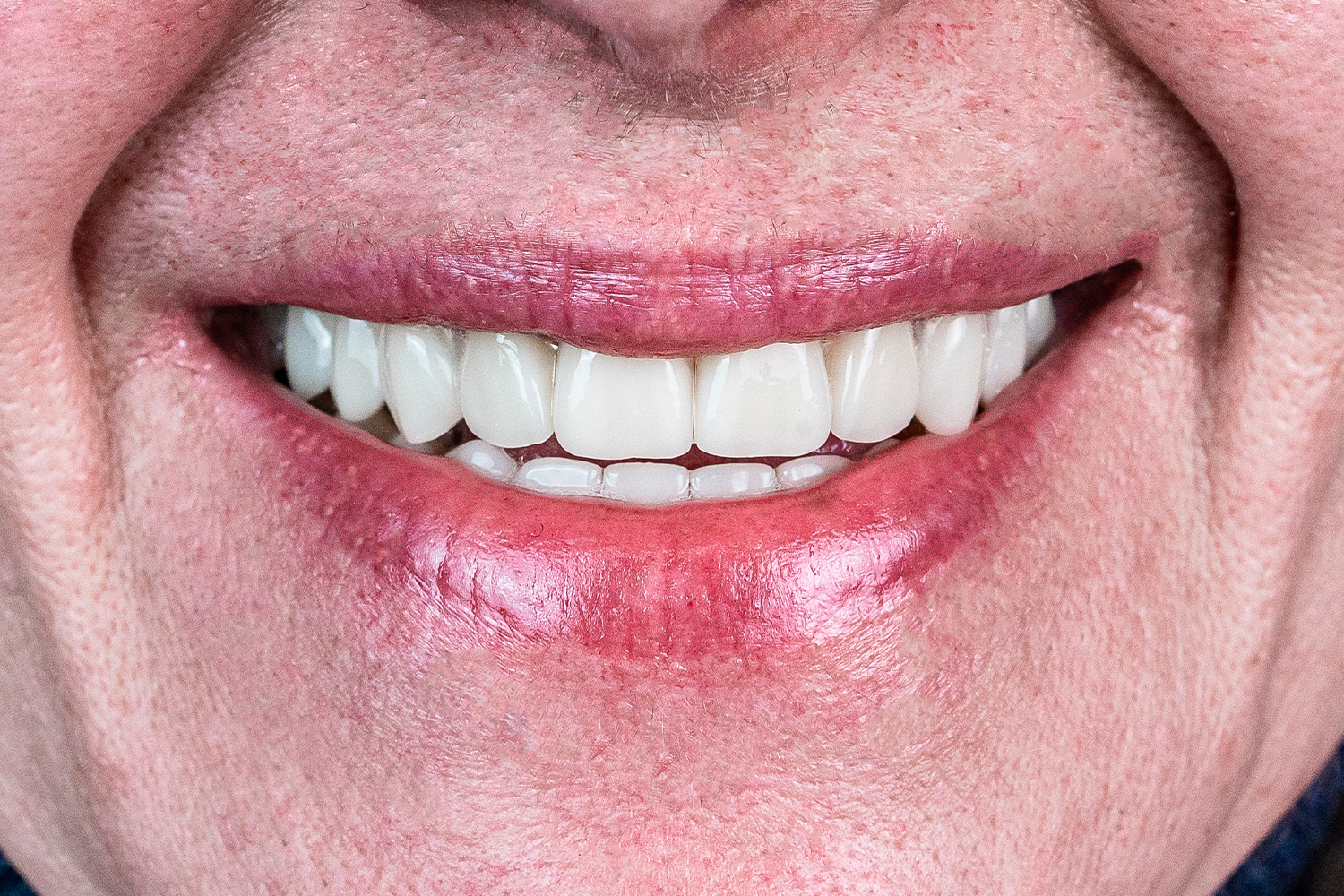 Імплантація та протезування коронками e.max